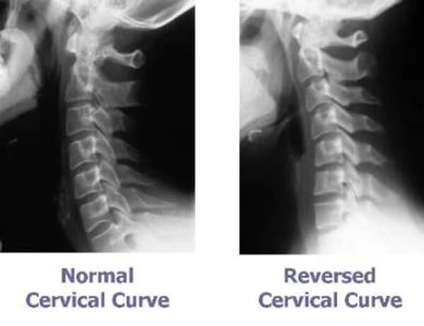 cervical curve
