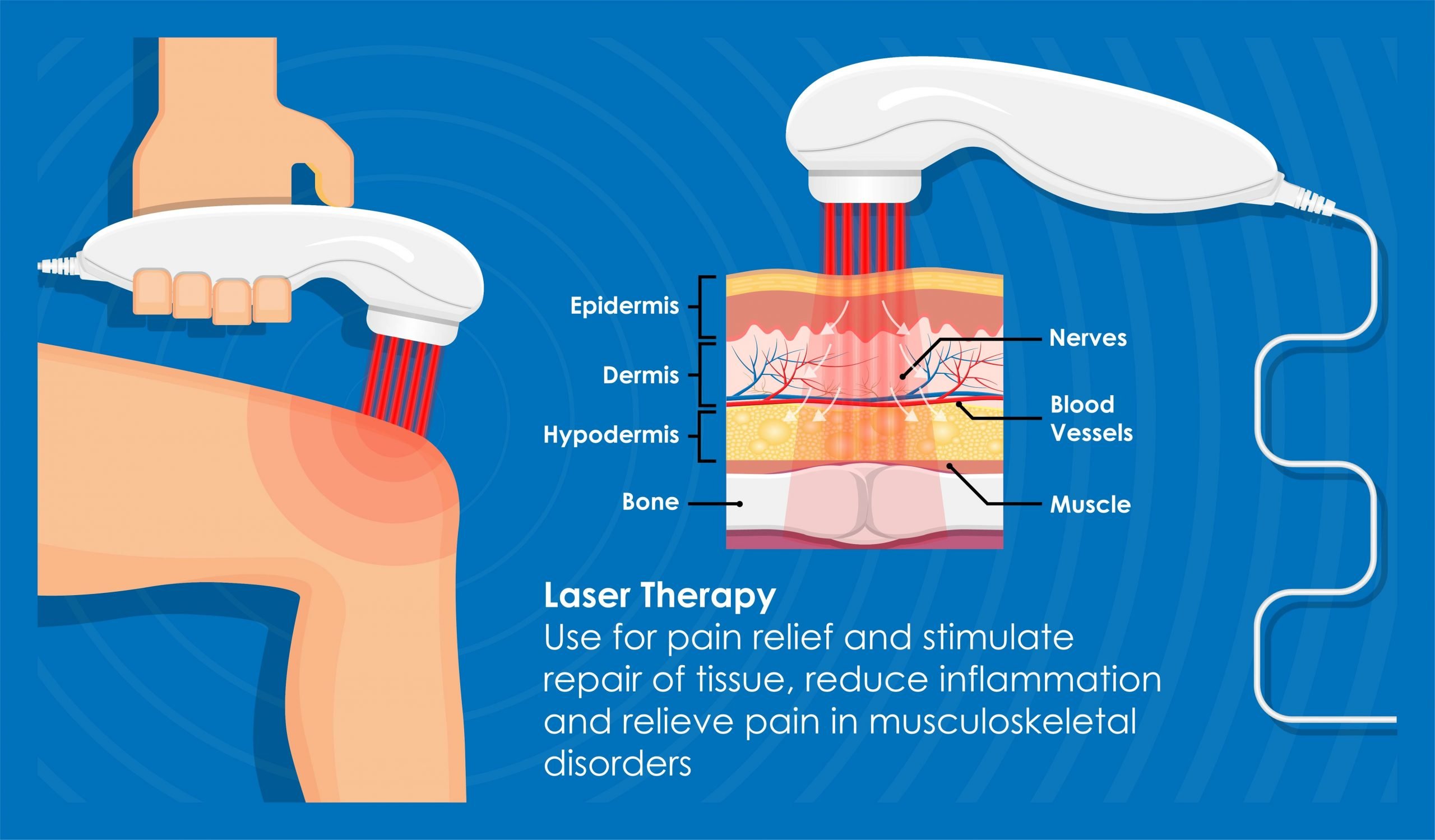 Laser therapy for back pain: Benefits and more